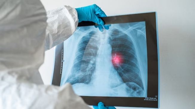 Penderita Kanker Paru-Paru pada tempat Indonesia Jauh Lebih Muda Dibandingkan Luar Negeri, Rokok Jadi Biang Kerok